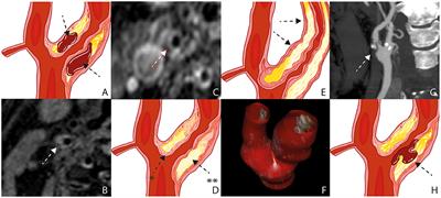 Carotid Plaque Composition and the Importance of Non-Invasive in Imaging Stroke Prevention